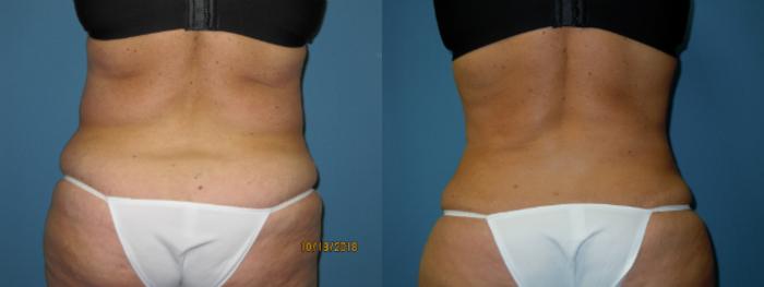 Before & After Liposuction - Abdomen / Flanks Case 134 View #5 View in Coeur d'Alene, ID