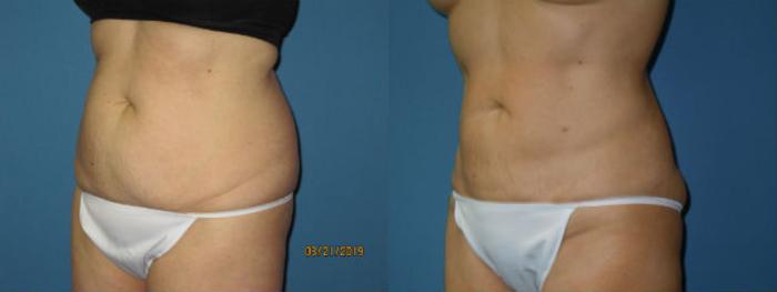 Before & After Liposuction - Abdomen / Flanks Case 135 View #1 View in Coeur d'Alene, ID