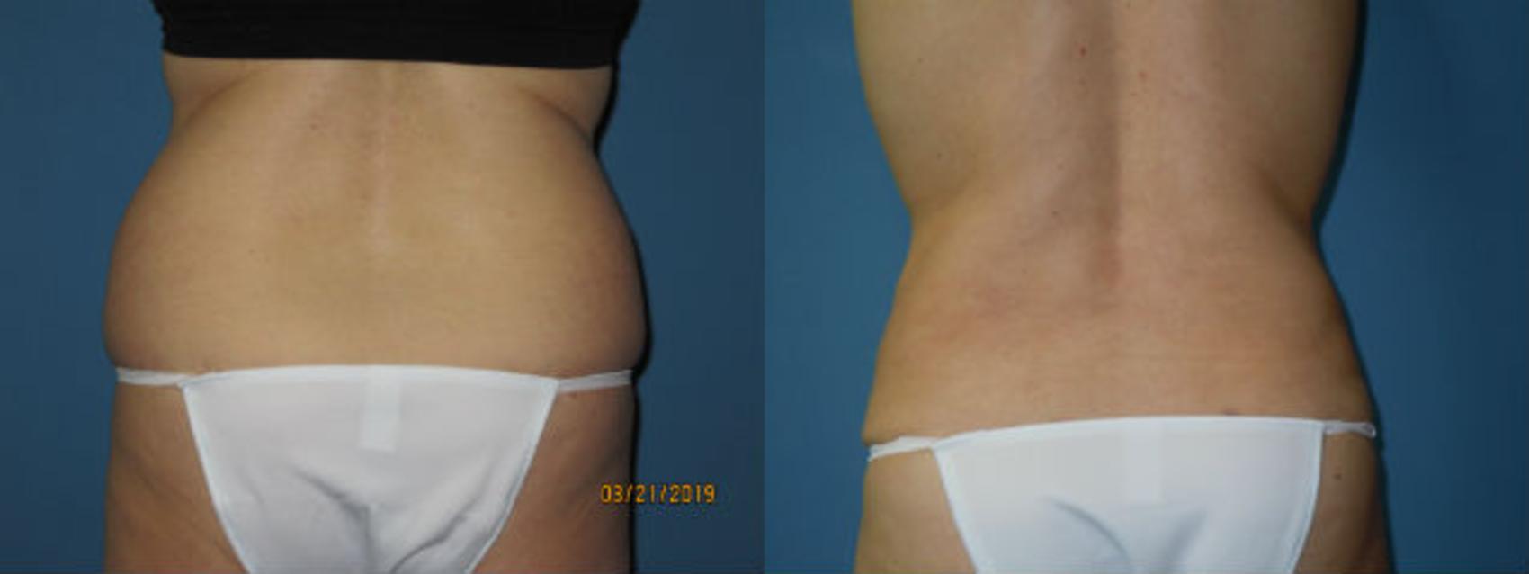 Before & After Liposuction - Abdomen / Flanks Case 135 View #2 View in Coeur d'Alene, ID
