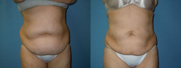 Before & After Liposuction - Abdomen / Flanks Case 137 View #1 View in Coeur d'Alene, ID