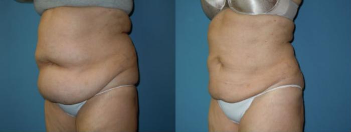 Before & After Liposuction - Abdomen / Flanks Case 137 View #2 View in Coeur d'Alene, ID