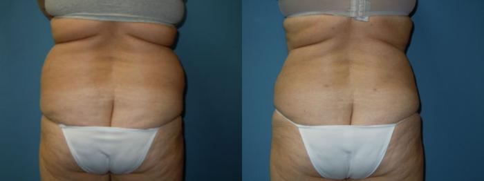 Before & After Liposuction - Abdomen / Flanks Case 137 View #3 View in Coeur d'Alene, ID