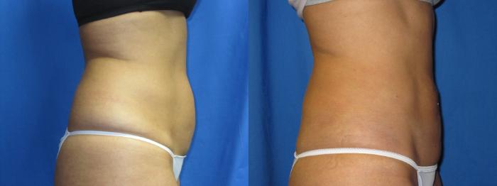 Before & After Liposuction - Abdomen / Flanks Case 14 View #1 View in Coeur d'Alene, ID