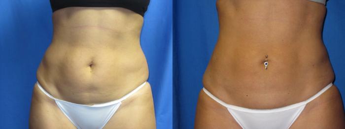 Liposuction of Flanks Before and After 3804