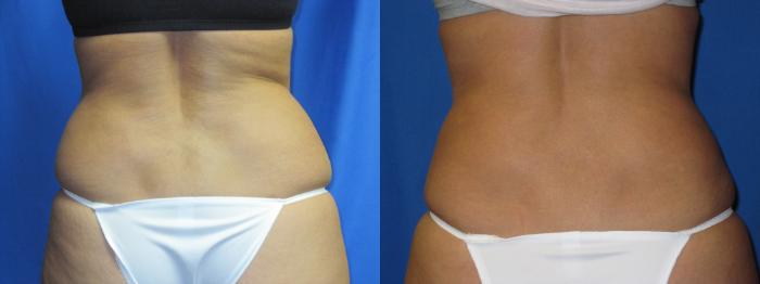 Flanks Liposuction  Before and After Photos - Palm Clinic