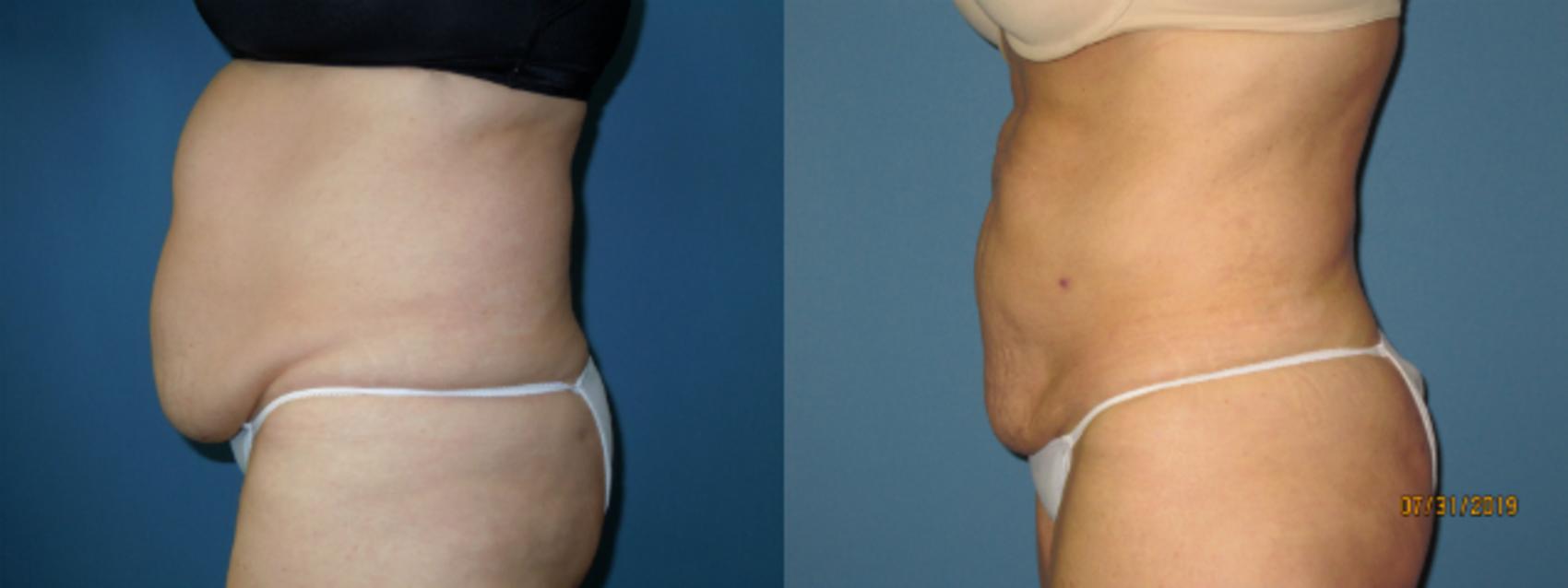 Before & After Liposuction - Abdomen / Flanks Case 140 View #1 View in Coeur d'Alene, ID