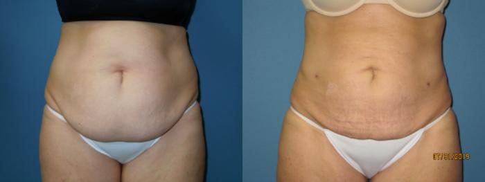 Before & After Liposuction - Abdomen / Flanks Case 140 View #2 View in Coeur d'Alene, ID
