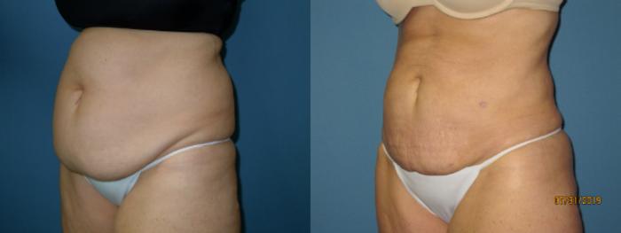 Before & After Liposuction - Abdomen / Flanks Case 140 View #3 View in Coeur d'Alene, ID
