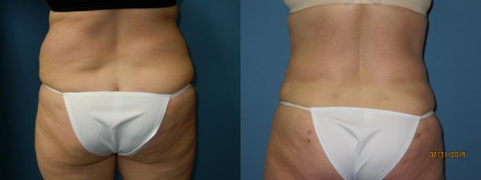 Before & After Liposuction - Abdomen / Flanks Case 140 View #4 View in Coeur d'Alene, ID