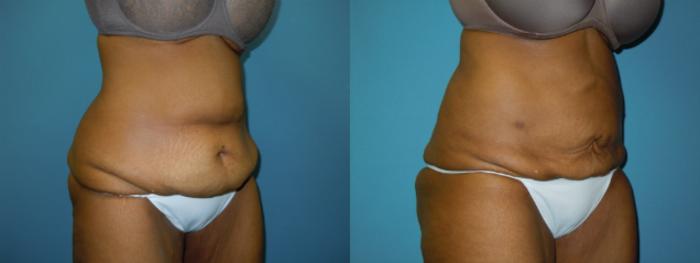 Before & After Liposuction - Abdomen / Flanks Case 141 View #1 View in Coeur d'Alene, ID