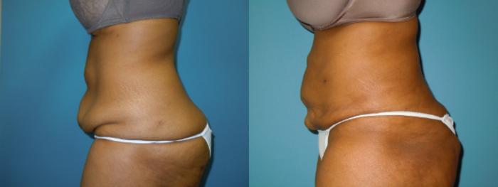 Before & After Liposuction - Abdomen / Flanks Case 141 View #2 View in Coeur d'Alene, ID