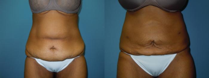 Before & After Liposuction - Abdomen / Flanks Case 141 View #3 View in Coeur d'Alene, ID