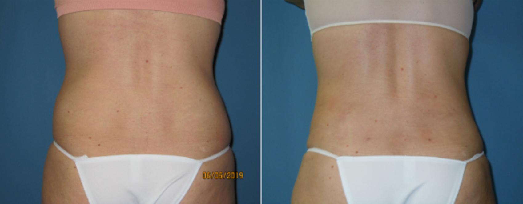 Before & After Liposuction - Abdomen / Flanks Case 142 View #1 View in Coeur d'Alene, ID