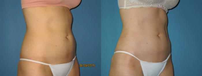 Before & After Liposuction - Abdomen / Flanks Case 142 View #2 View in Coeur d'Alene, ID