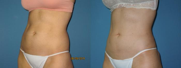 Before & After Liposuction - Abdomen / Flanks Case 142 View #3 View in Coeur d'Alene, ID