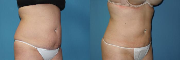 Smartlipo Flanks Liposuction for Women - Before & After Photos