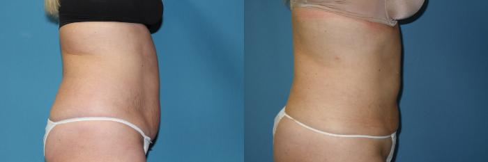 Before & After Liposuction - Abdomen / Flanks Case 145 View #2 View in Coeur d'Alene, ID