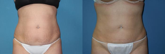 Before & After Liposuction - Abdomen / Flanks Case 145 View #3 View in Coeur d'Alene, ID