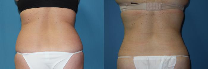 Smartlipo Flanks Liposuction for Women - Before & After Photos