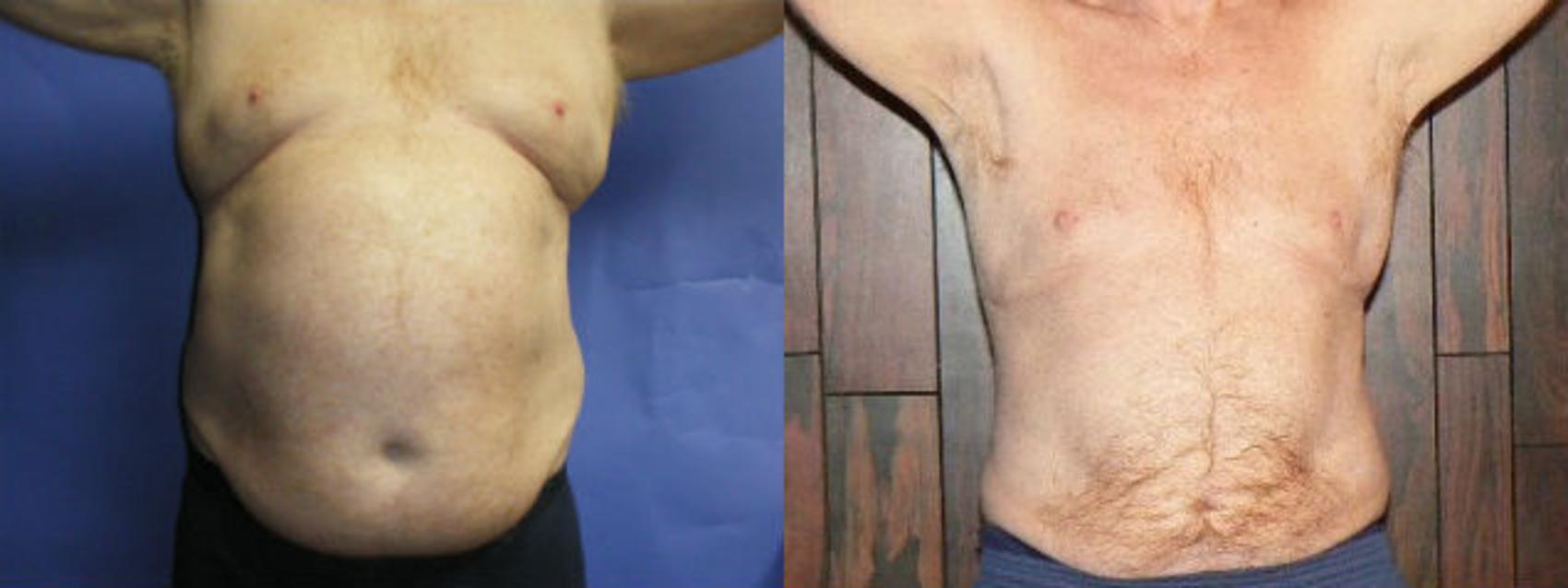 Before & After Liposuction - Male Chest Case 15 View #1 View in Coeur d'Alene, ID