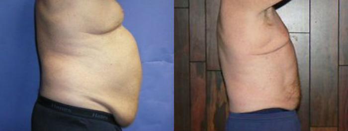 Before & After Liposuction - Abdomen / Flanks Case 15 View #2 View in Coeur d'Alene, ID