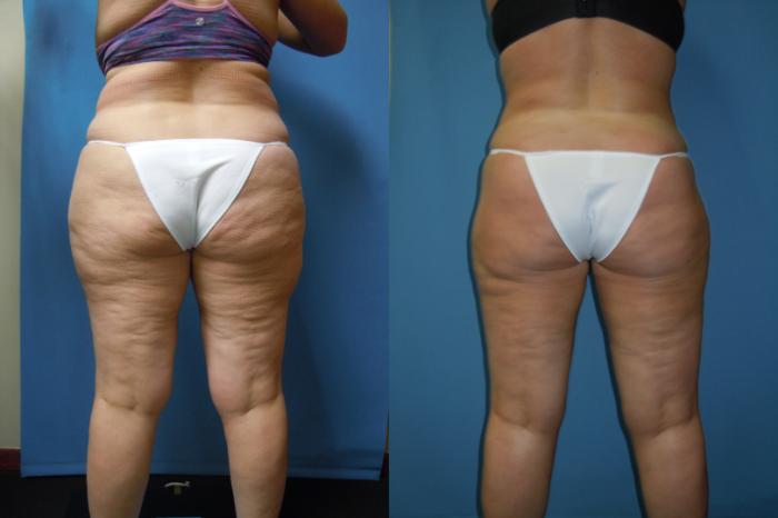 Before & After Liposuction - Abdomen / Flanks Case 165 Back View in Coeur d'Alene, ID