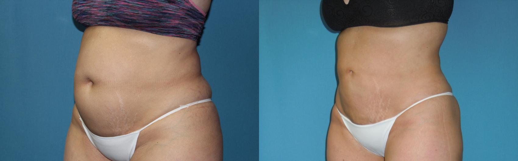 Before & After Liposuction - Abdomen / Flanks Case 165 Left Oblique View in Coeur d'Alene, ID