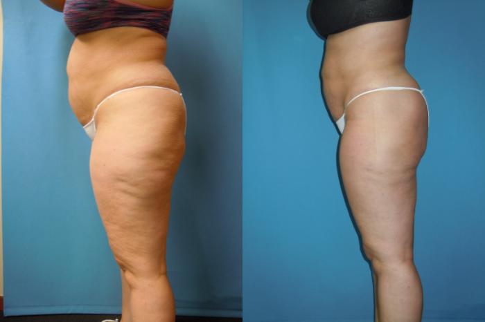 Before & After Liposuction - Abdomen / Flanks Case 165 Left Side View in Coeur d'Alene, ID