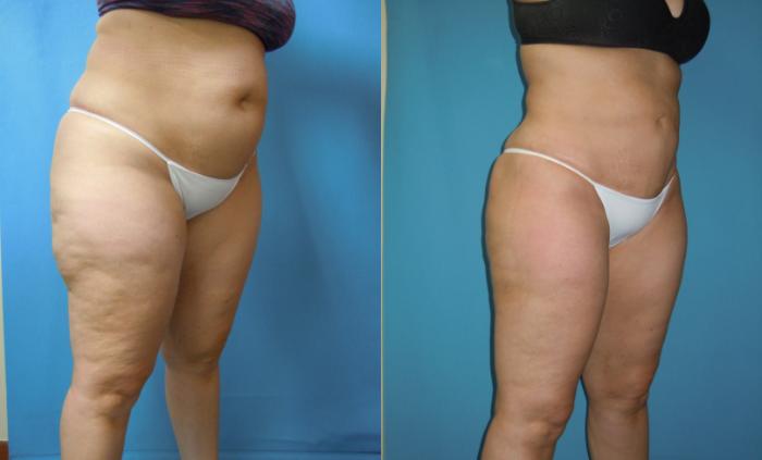 Before & After Liposuction - Abdomen / Flanks Case 165 Right Oblique View in Coeur d'Alene, ID