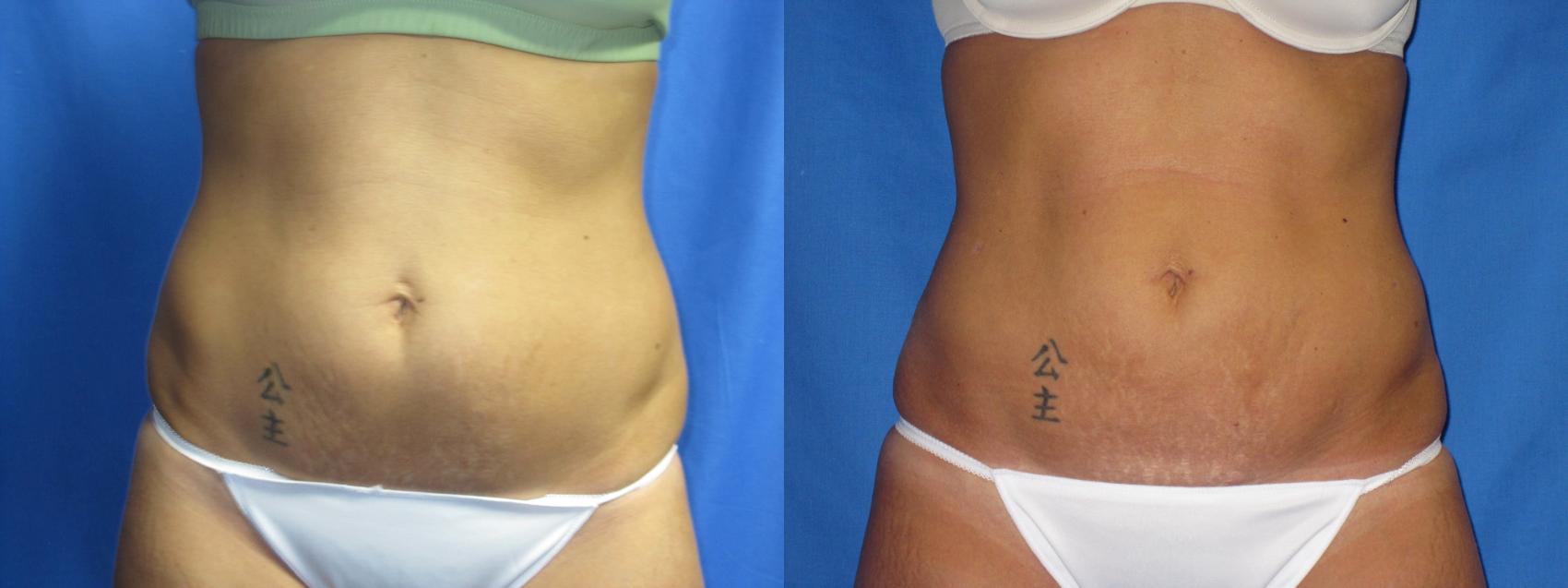Before & After Liposuction - Abdomen / Flanks Case 17 View #1 View in Coeur d'Alene, ID