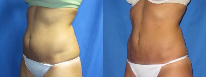 Before & After Liposuction - Abdomen / Flanks Case 17 View #2 View in Coeur d'Alene, ID