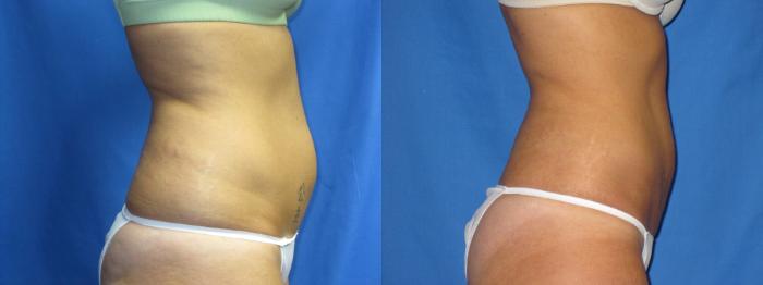 Before & After Liposuction - Abdomen / Flanks Case 17 View #3 View in Coeur d'Alene, ID
