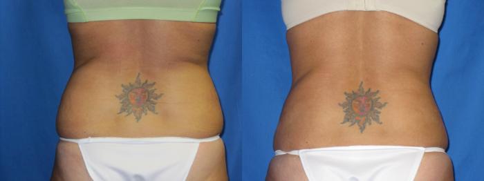 Liposuction - Arms / Axillary Before and After Pictures Case 48, Coeur  d'Alene, ID
