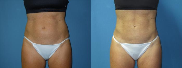 Before & After Liposuction - Abdomen / Flanks Case 171 Front View in Coeur d'Alene, ID