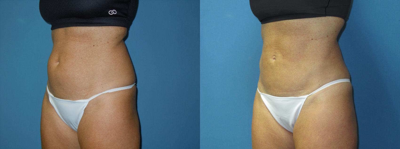 Before & After Liposuction - Abdomen / Flanks Case 171 Left Oblique View in Coeur d'Alene, ID