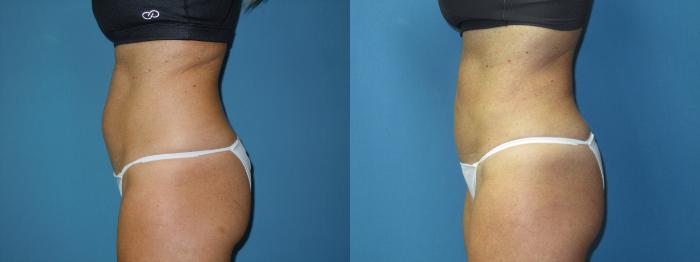 Before & After Liposuction - Abdomen / Flanks Case 171 Left Side View in Coeur d'Alene, ID