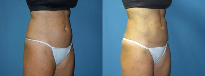 Before & After Liposuction - Abdomen / Flanks Case 171 Right Oblique View in Coeur d'Alene, ID