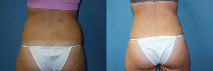Before & After Liposuction - Abdomen / Flanks Case 172 Back View in Coeur d'Alene, ID
