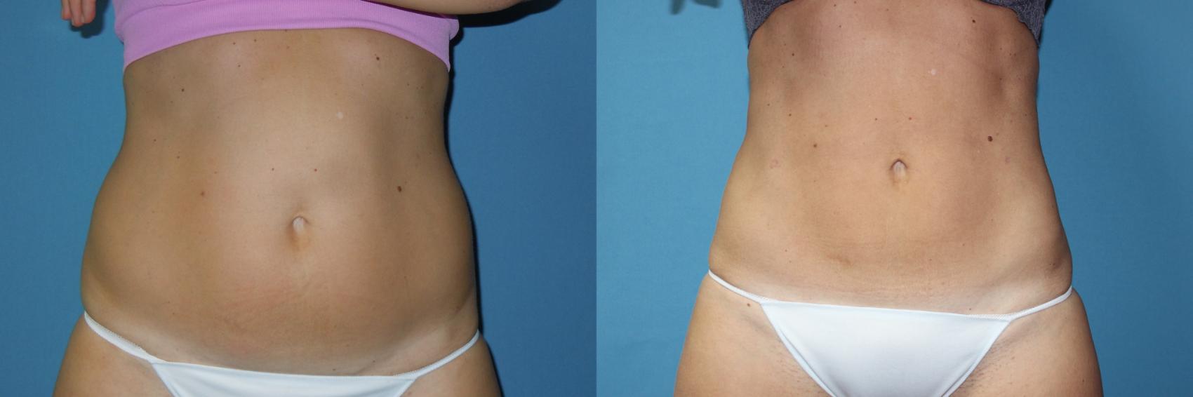 Before & After Liposuction - Abdomen / Flanks Case 172 Front View in Coeur d'Alene, ID