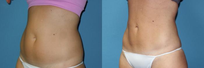 Before & After Liposuction - Abdomen / Flanks Case 172 Left Oblique View in Coeur d'Alene, ID