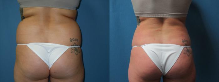 Before & After Liposuction - Abdomen / Flanks Case 173 Back View in Coeur d'Alene, ID