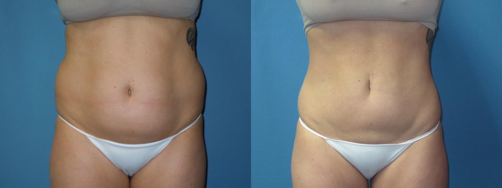 Before & After Liposuction - Abdomen / Flanks Case 173 Front View in Coeur d'Alene, ID