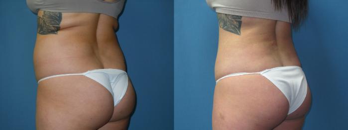 Before & After Liposuction - Abdomen / Flanks Case 173 Left Oblique View in Coeur d'Alene, ID