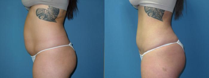 Before & After Liposuction - Abdomen / Flanks Case 173 Left Side View in Coeur d'Alene, ID