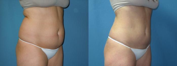 Before & After Liposuction - Abdomen / Flanks Case 173 Right Oblique View in Coeur d'Alene, ID
