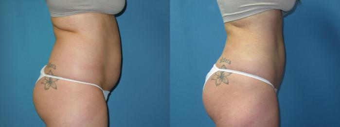 Before & After Liposuction - Abdomen / Flanks Case 173 Right Side View in Coeur d'Alene, ID