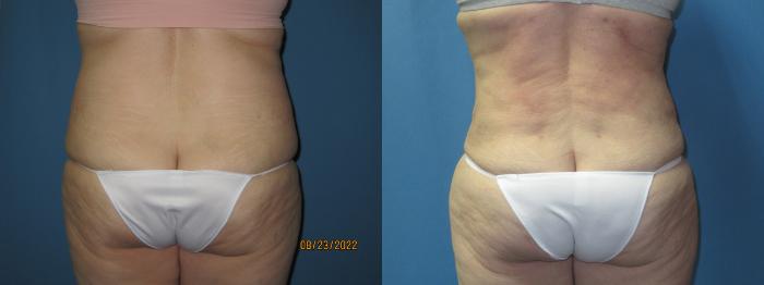 Before & After Liposuction - Abdomen / Flanks Case 175 Back View in Coeur d'Alene, ID