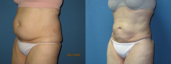 Before & After Liposuction - Abdomen / Flanks Case 175 Left Oblique View in Coeur d'Alene, ID