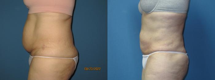 Before & After Liposuction - Abdomen / Flanks Case 175 Left Side View in Coeur d'Alene, ID