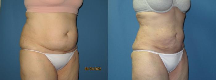 Before & After Liposuction - Abdomen / Flanks Case 175 Right Oblique View in Coeur d'Alene, ID